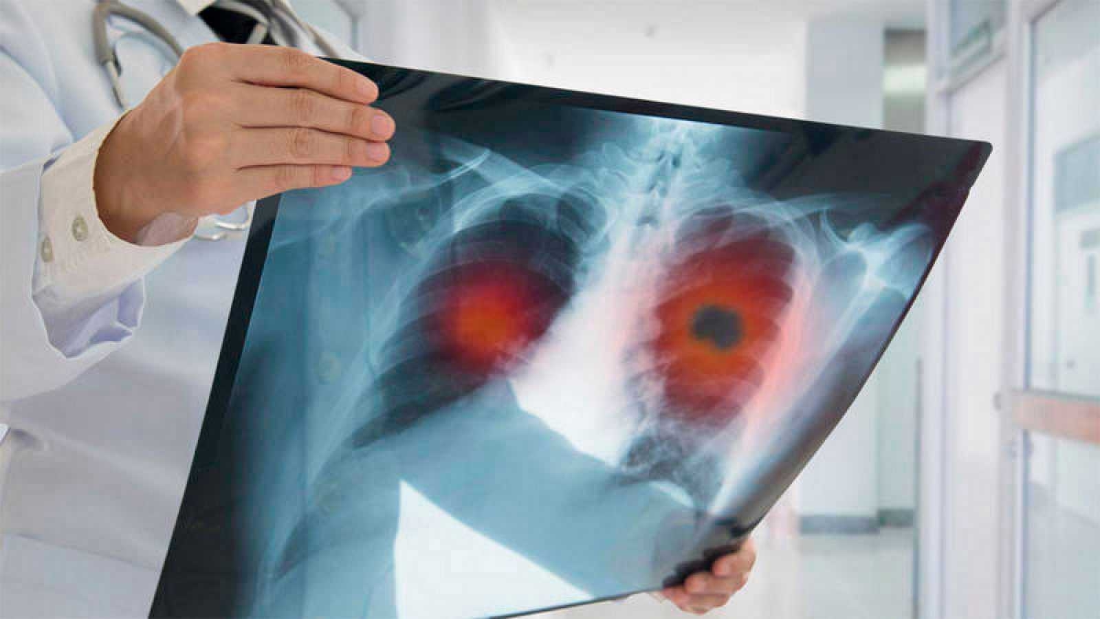 La incidencia del cáncer sube un 10% en mujeres y un 3% en hombres en 10 años
