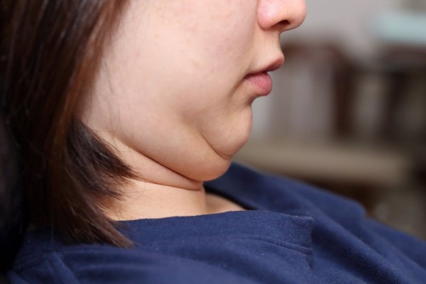 ¡Ojo a la grasa en el cuello!, aumenta las posibilidades de sufrir problemas de corazón, según un estudio
