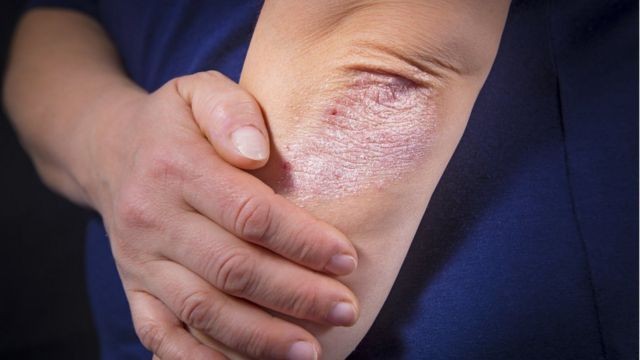 Un compuesto desarrollado por investigadores de la UMH reduce el picor de la psoriasis sin producir efectos secundarios
