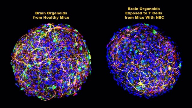 Un estudio realizado en ratones halla un vínculo entre la enfermedad intestinal y la lesión cerebral en prematuros
