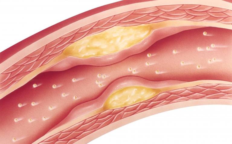 Los triglicéridos y el colesterol aumentan el riesgo de cardiopatías, según un estudio
