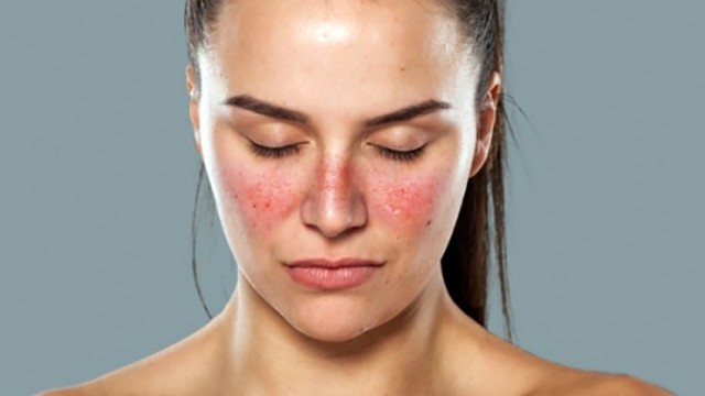 Evitar tomar el sol, fumar, beber alcohol y tener actualizado el calendario vacunal, consejos para pacientes con lupus