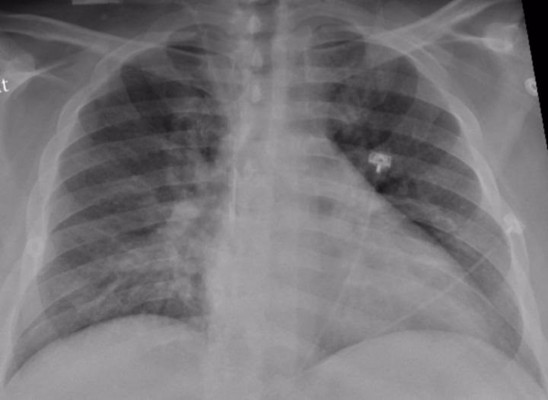 La mayoría de los pulmones se recuperan bien tres meses después del pasar la covid-19 con gravedad
