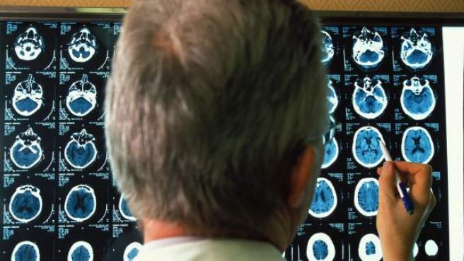 Un estudio identifica cambios cerebrales veinte años antes del diagnóstico del Alzheimer
