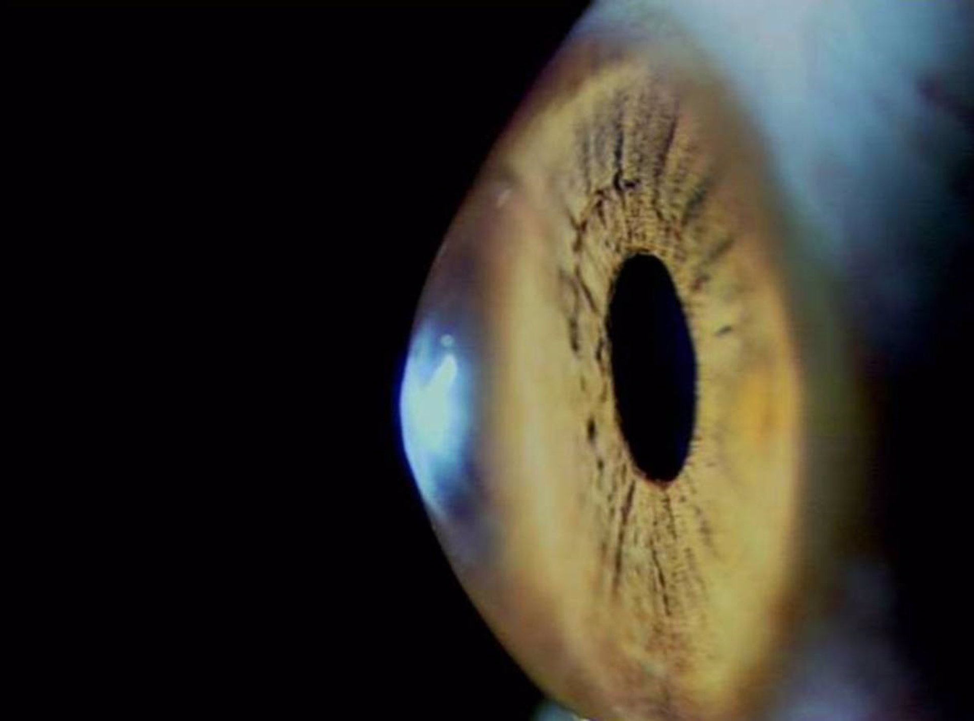 La córnea del ojo parece resistir a la infección de la covid