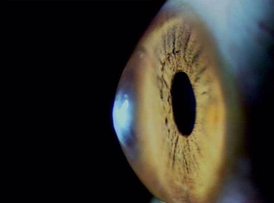 La córnea del ojo parece resistir a la infección de la covid
