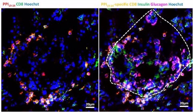 Investigadores de la diabetes detectan células T peligrosas en el páncreas, incluso en personas sanas
