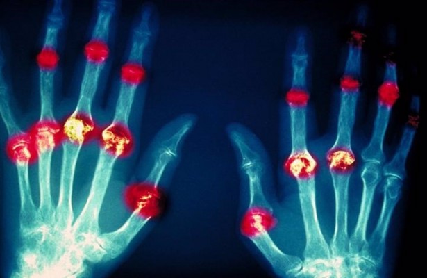 El dolor, el síntoma que más impacta en la vida de las personas con artritis reumatoide
