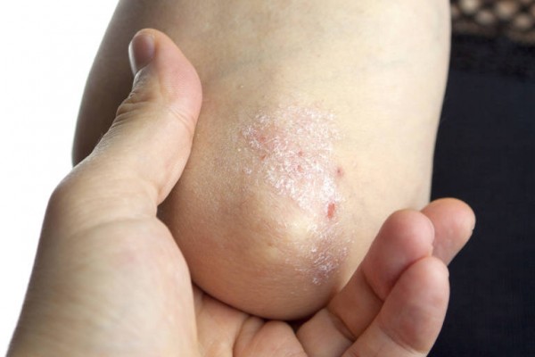 Seis de cada diez murcianos con psoriasis no recibe tratamiento
