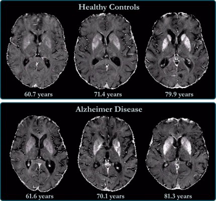 El Instituto de Neurociencias (UMH) descubre una nueva alteración en el cerebro de las personas con Alzheimer