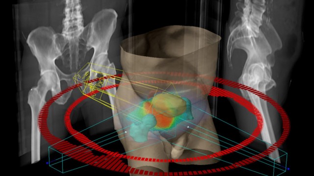 Un tratamiento con nanopartículas para el cáncer de próstata 