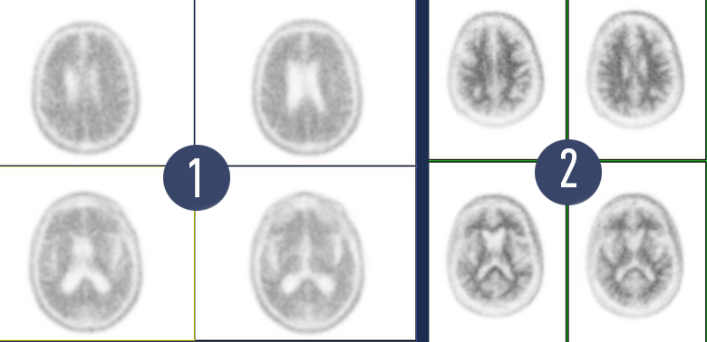 Vithas Valencia 9 de Octubre avanza en el diagnóstico precoz del alzhéimer