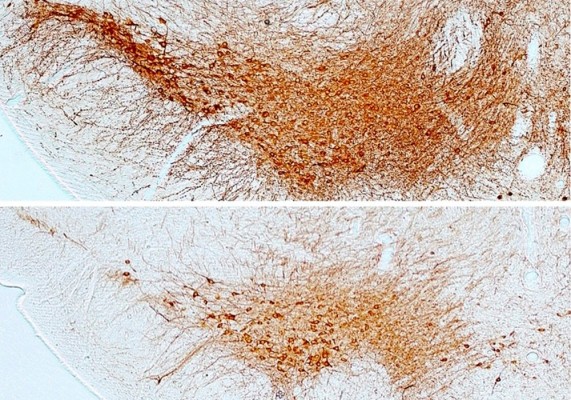 Demuestran que la diabetes es un factor de riesgo para desarrollar Parkinson