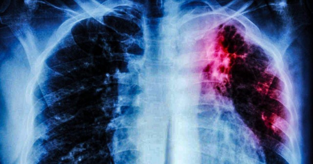 Tuberculosis: un nuevo método acorta el tiempo de diagnóstico y epidemiología
