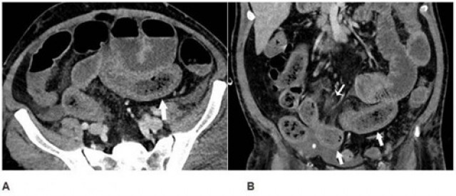 Identifican una biomolécula que puede mejorar la reparación del revestimiento del intestino