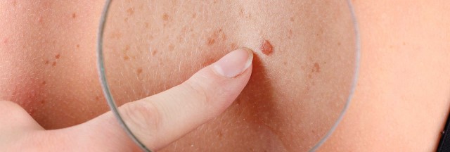 Cuatro de cada diez españoles sufrirá de cáncer de piel a lo largo de su vida