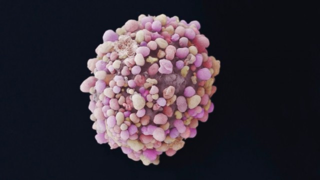 Un estudio evidencia que las mutaciones en el gen ESR1 pueden predecir el pronóstico del cáncer de mama hormonal