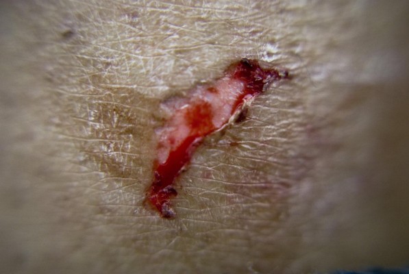 Diseñan un bioadhesivo para el cierre de heridas en humanos que permite regenerar tejidos