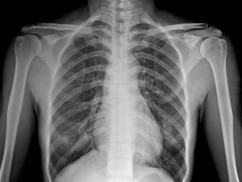 Innovación impulsa un proyecto para el diagnóstico precoz de pacientes de CoVid-19 mediante IA