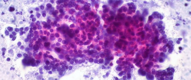 Un descubrimiento sobre las células inmunes abre la puerta a potentes terapias contra el cáncer

