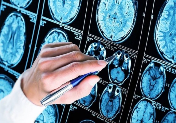Una investigación apunta que una serie de células en el cerebro pueden ser claves en el Alzheimer