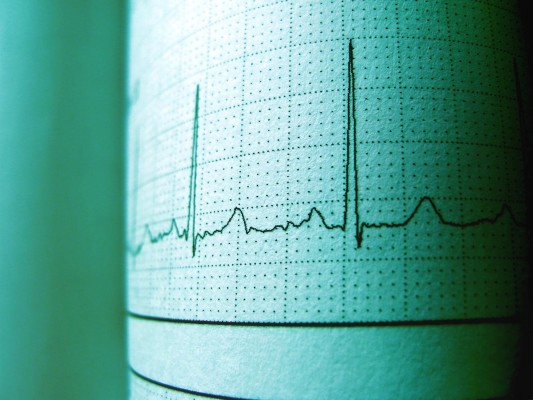 La demencia triplica el riesgo de muerte en pacientes con fibrilación auricular