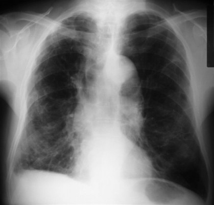 Crean una 'camisa inteligente' que mide la respiración y controla la enfermedad pulmonar