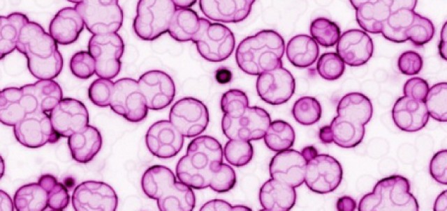 La Fe participa en dos ensayos mundiales con fármacos para pacientes con leucemia