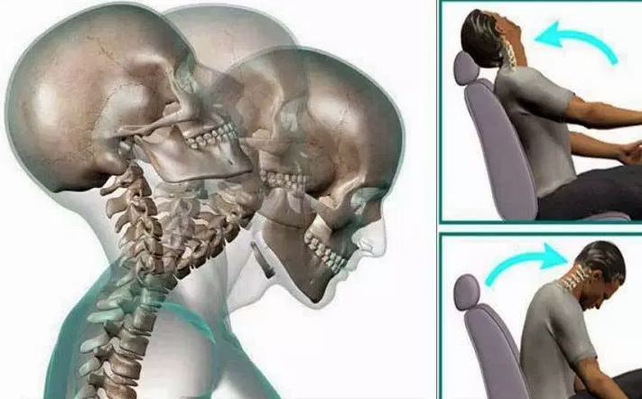 El latigazo cervical afecta hasta al 30% de las víctimas de accidentes de tráfico, según expertos