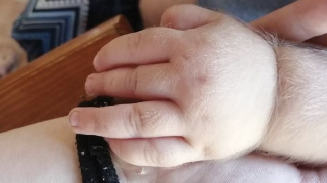 Tres bebés valencianos, entre los 17 afectados por el síndrome del hombre lobo