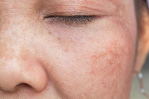 Los expertos destacan los cosméticos y el láser como los tratamientos más efectivos para las manchas en la piel