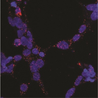 Investigadores identifican una posible diana terapéutica para el cáncer de próstata y una enfermedad rara
