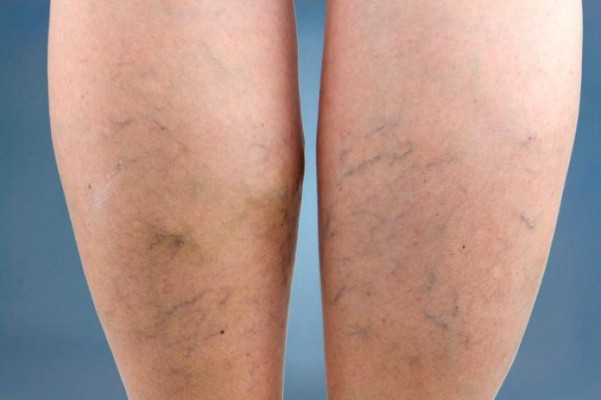 El 35% de los hombres tiene varices, que provocan dolor, pesadez e hinchazón