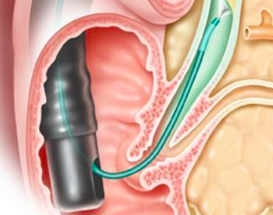 Una nueva técnica avanza notablemente en el diagnóstico de cáncer en vías biliares