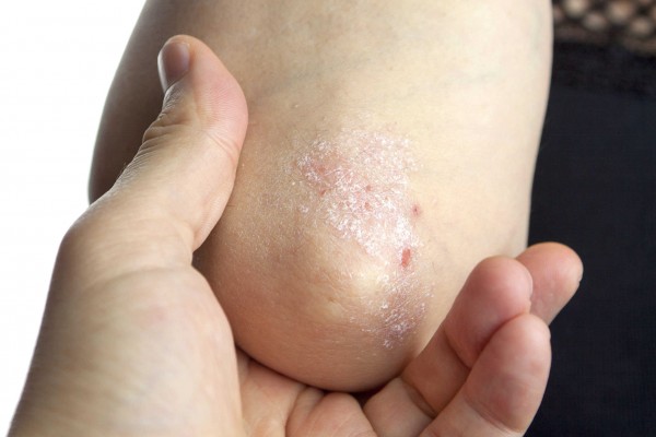 Los pacientes con psoriasis recurren a terapias alternativas cuando les fallan las tradicionales
