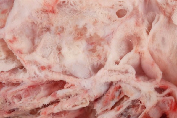 Un nuevo análisis de sangre podría mejorar el diagnóstico del cáncer de ovario sin necesidad de cirugía