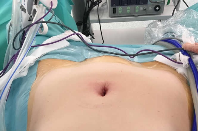 La cirugía de puerto único en miomas uterinos reduce a la mitad el tiempo de hospitalización