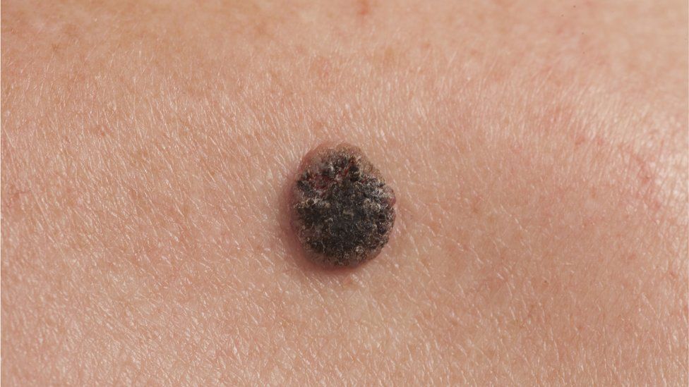 Cambios de color, forma y tamaño de un lunar, señales de alerta de melanoma