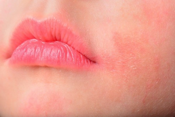 La dermatitis atópica repercute muy negativamente en la calidad de vida de los pacientes