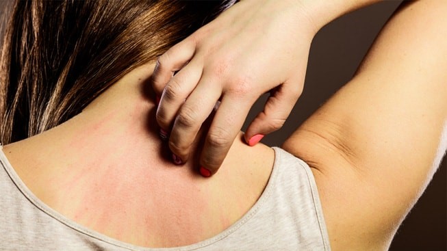 El doctor Beteta explica qué es y por qué se produce una erupción polimorfa lumínica o alergia al sol
