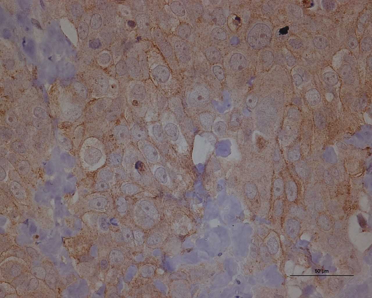 Investigadores identifican un nuevo gen implicado en el síndrome de ovario poliquístico