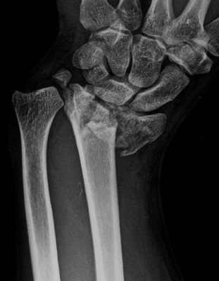 Los pacientes con riesgo cardiovascular padecen más osteoporosis y fracturas, según un experto