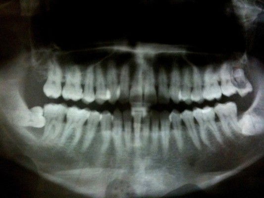  La periodontitis puede ser un factor de riesgo para desarrollar demencia, según un estudio