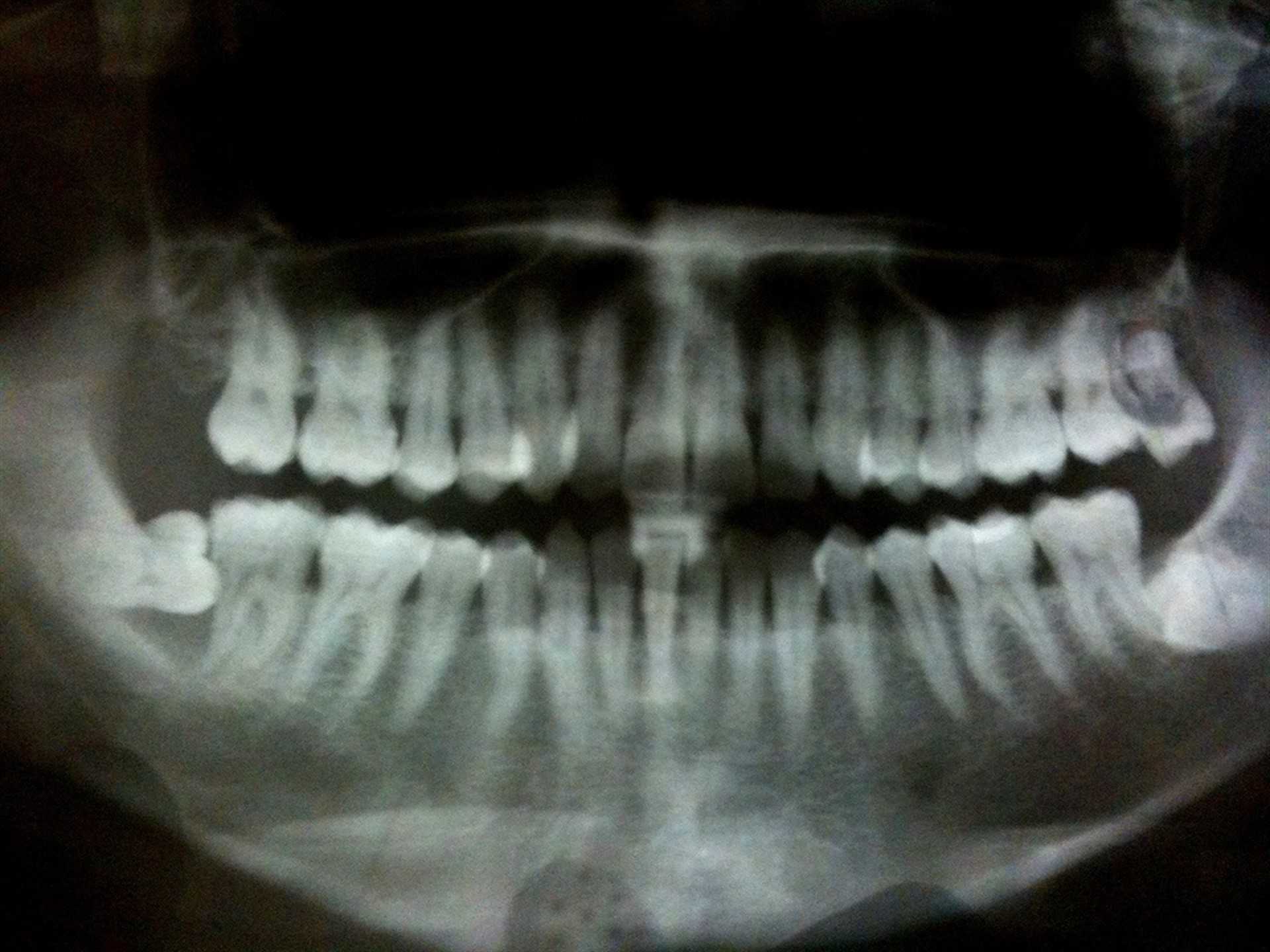  La periodontitis puede ser un factor de riesgo para desarrollar demencia, según un estudio