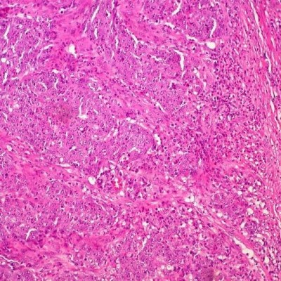 Un estudio confirma que hacer la prueba de heces en casa es lo más eficaz para detectar el cáncer de colon