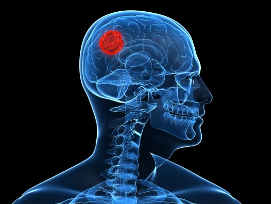 Algunos síntomas psiquiátricos podrían ser un signo de tumor cerebral