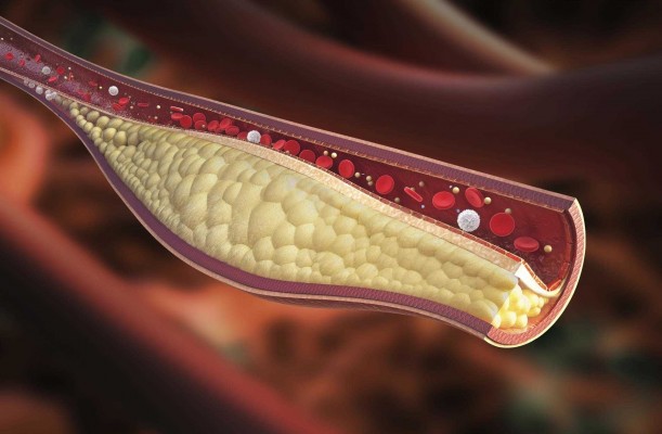 Un estudio español evidencia que comer de forma rápida conlleva niveles más altos de triglicéridos