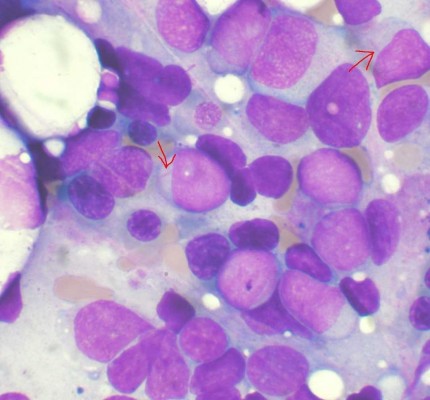 Investigan un fármaco que podría ser el tratamiento de próxima generación para la leucemia mieloide aguda