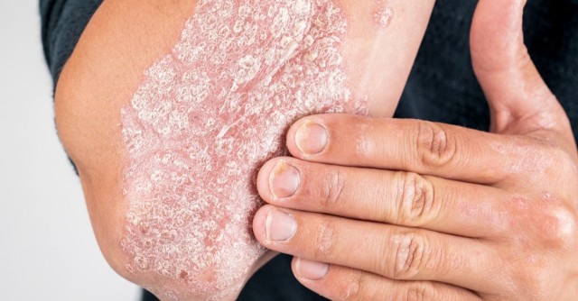 Los expertos advierten de que el frío intensifica los síntomas de la psoriasis, la artrosis o la dermatitis