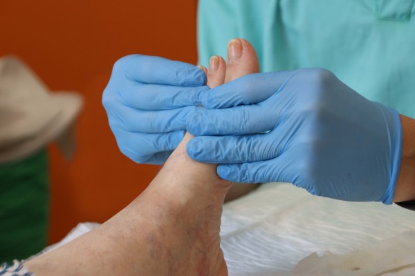 La embolización elimina el dolor de la fascitis plantar en pacientes que no responden a otros tratamientos 